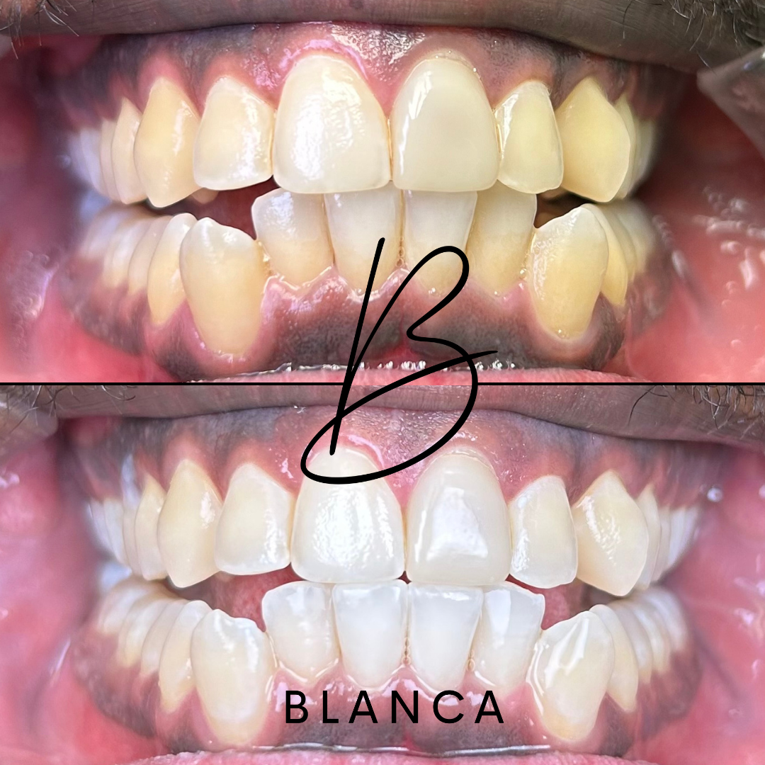 THE BLANCA TWENTY