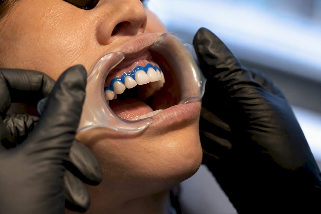 Clinician isolating teeth for whitening treatment